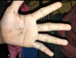 Puluhan Anak di Dusun Baninan Diduga Terpapar Cacar Monyet
